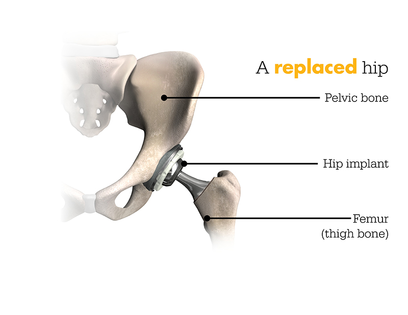 a replaced hip